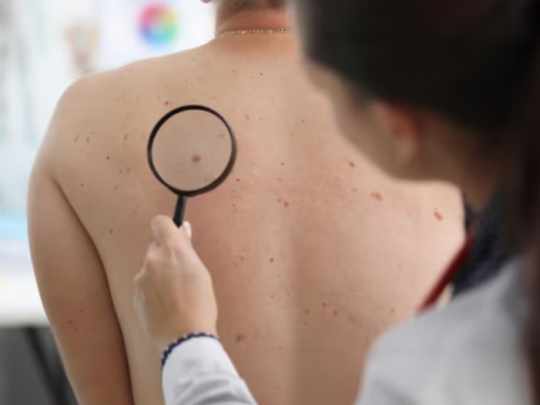 Avance contra el melanoma: una vacuna experimental logró resultados positivos en un ensayo clave